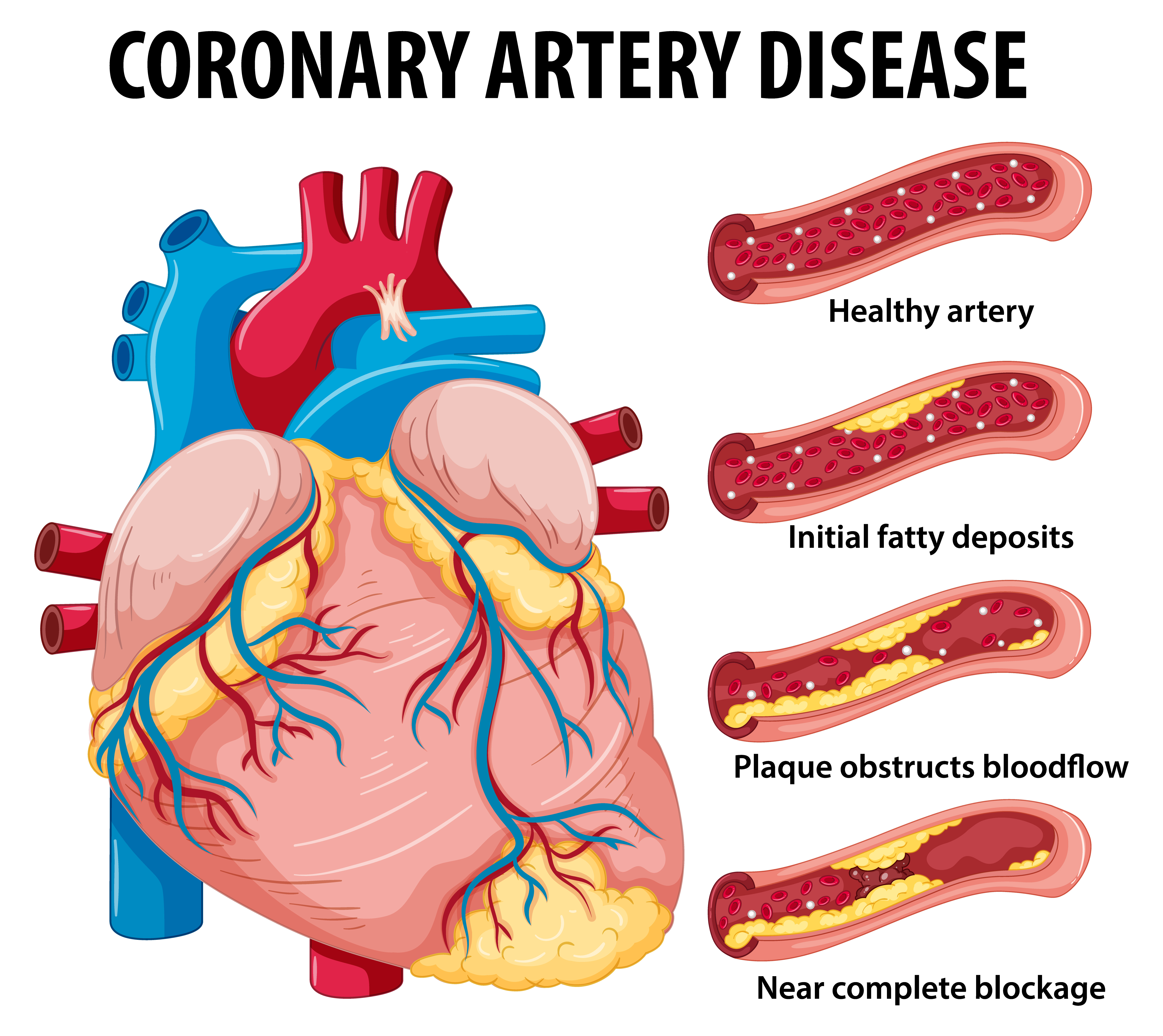 Picture showing coronary arteries from the heart become narrow or blocked by fatty deposits called plaque.