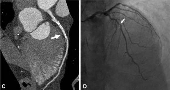 Picture showing diagnosis of Coronary Artery Disease via computerized tomography coronary angiogram on the left and invasive coronary angiography on the right.